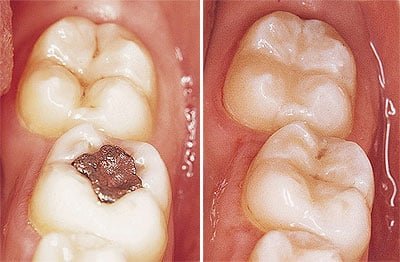 Komposit Kunststoff und Zahnfüllungen | Zahnarzt Wien