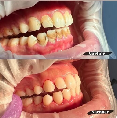 Politur der Zähne - Vorher/Nachher