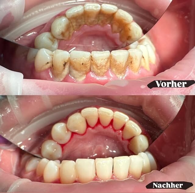 Gesundes Zahnfleisch