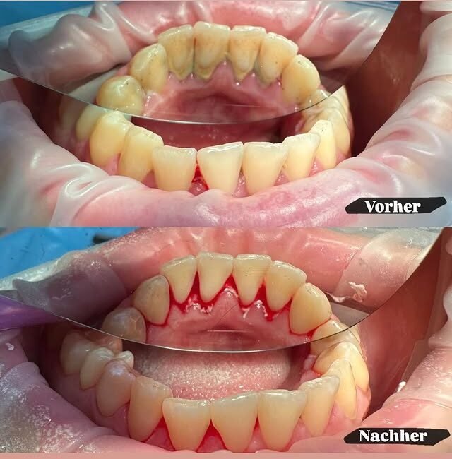 Gesundes Zahnfleisch