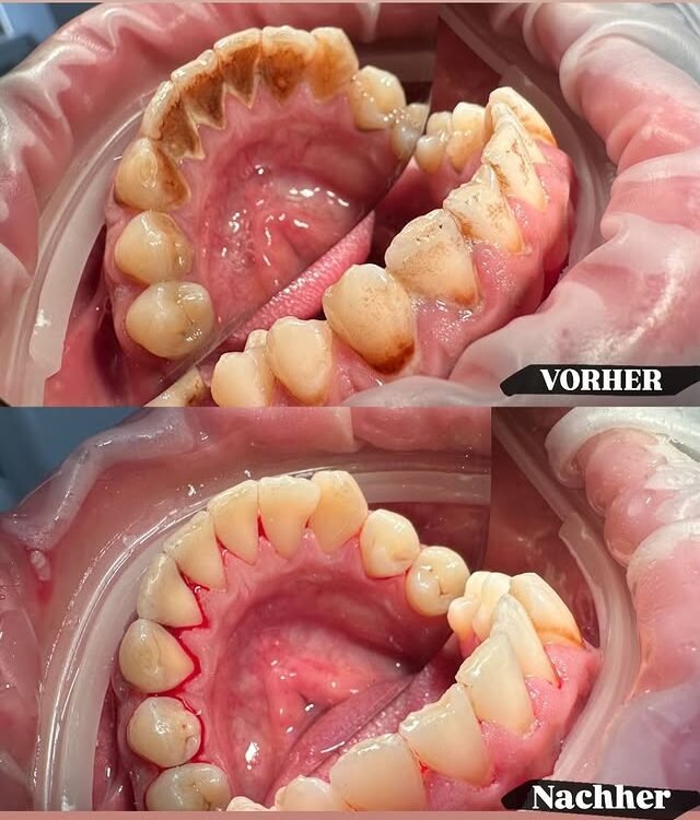 Ergebnis nach Mundhygiene