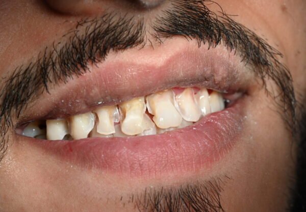 Vor Veneers Behandlung