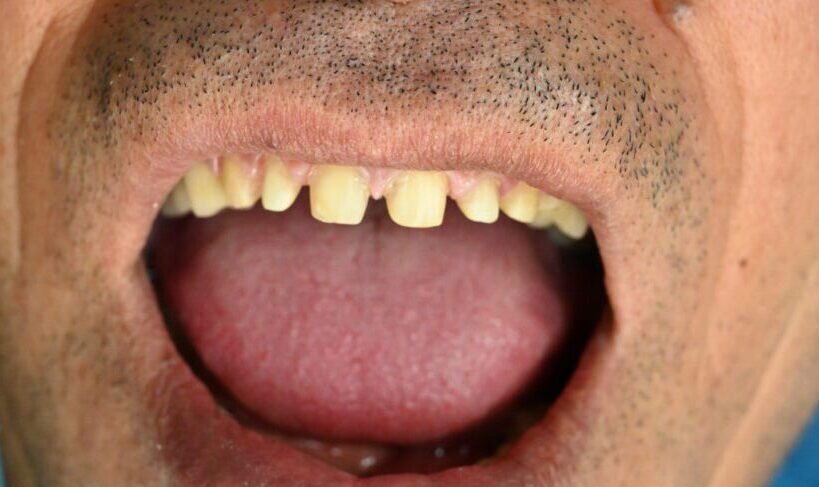 Vor Veneers Behandlung