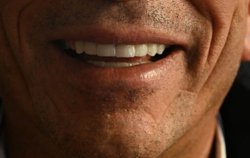 Nach Veneers Behandlung