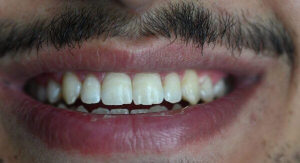 Nach Veneers Behandlung