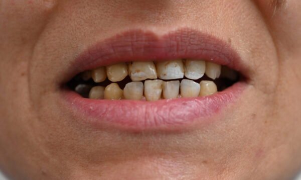 Vor Veneers Behandlung